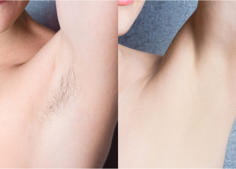 Benefits of Using Bzone IPL Hair Removal at Home